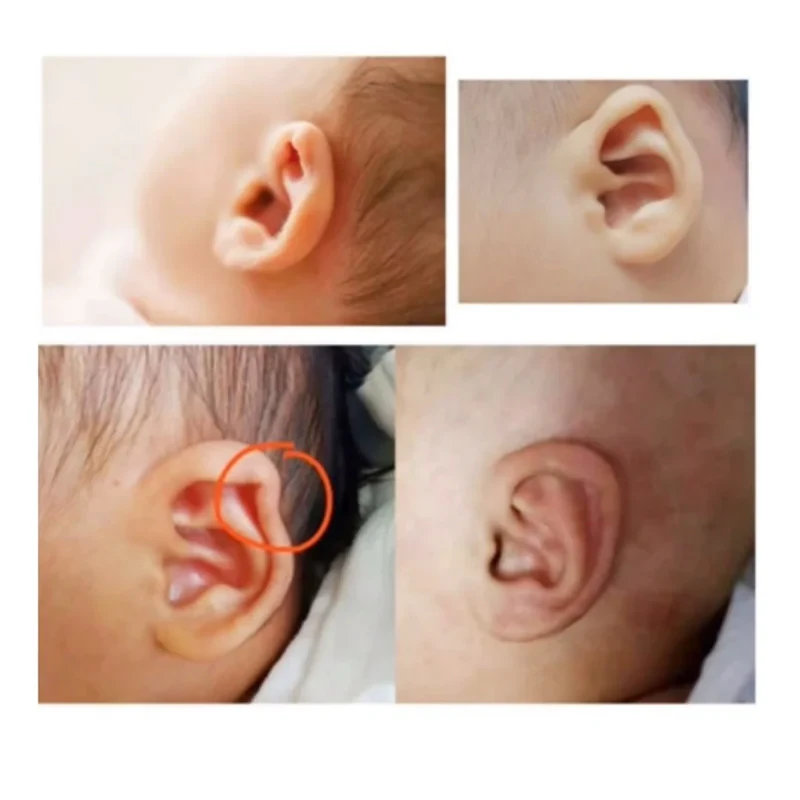 چسب اصلاح فرم گوش نوزاد کد 710