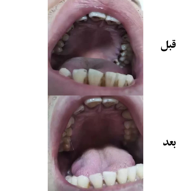 دستگاه جرم گیر دندان شارژی کروی مون مدل sonicare