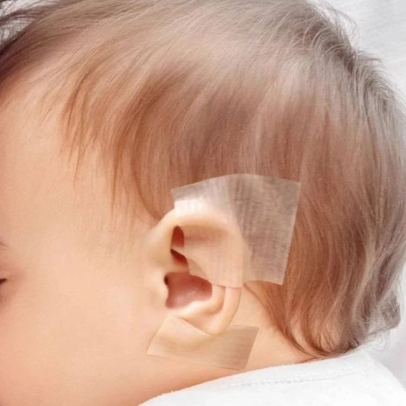 چسب اصلاح فرم گوش نوزاد مدل MK