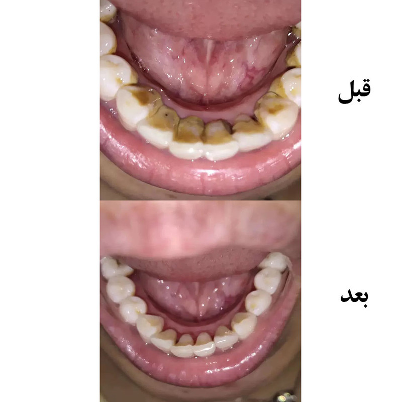 دستگاه جرم گیر دندان شارژی کروی مون مدل sonicare