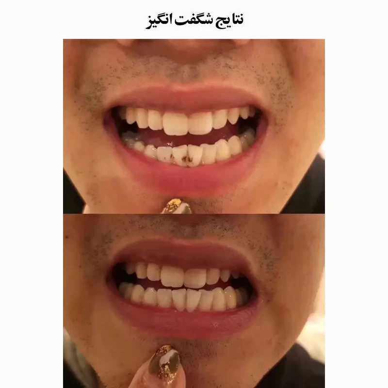 دستگاه جرم گیر دندان شارژی کروی مون مدل sonicare