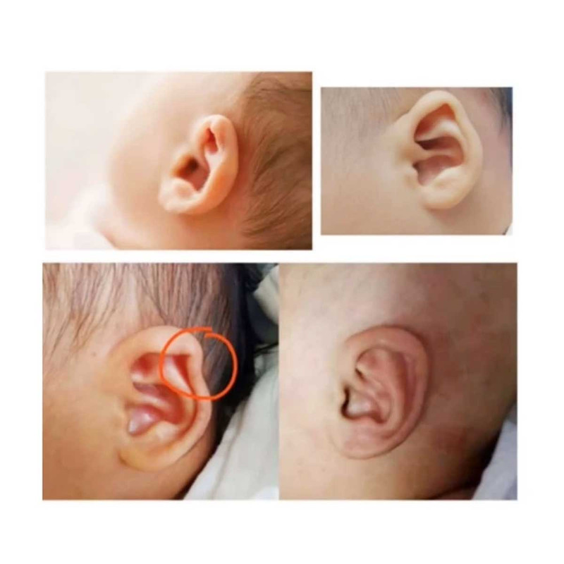 چسب اصلاح فرم گوش نوزاد مادرکر مدل 4100